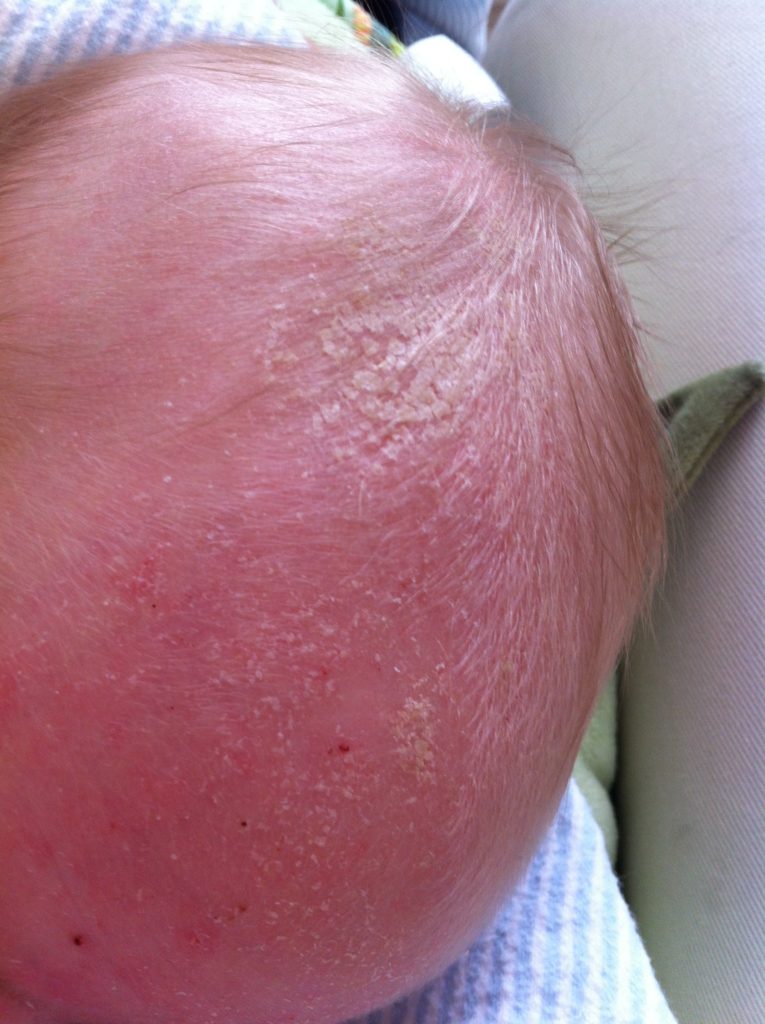 How to Get Rid of Cradle Cap | Mom Is Trying