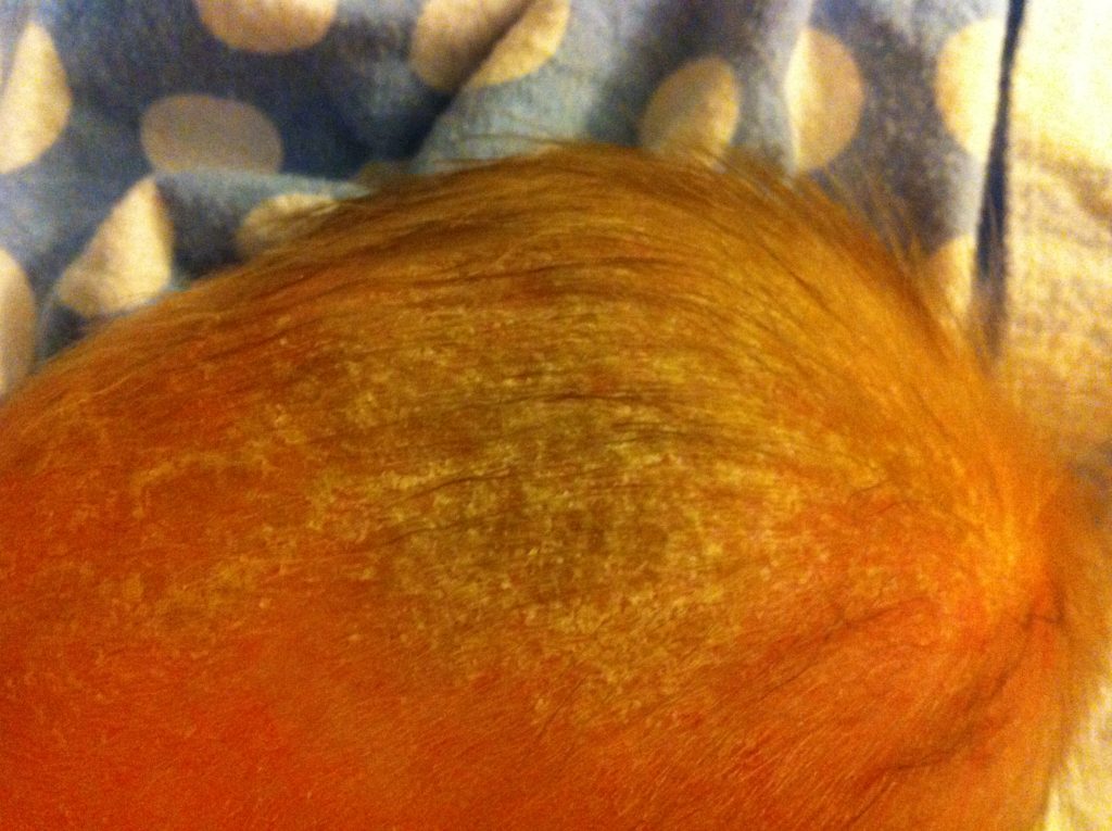 How to Get Rid of Cradle Cap | Mom Is Trying